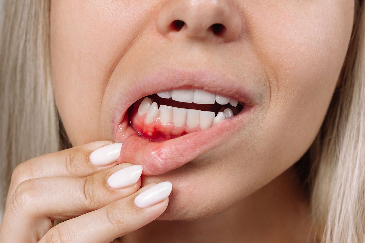 ulcerative stomatitis on gums gum inflammation