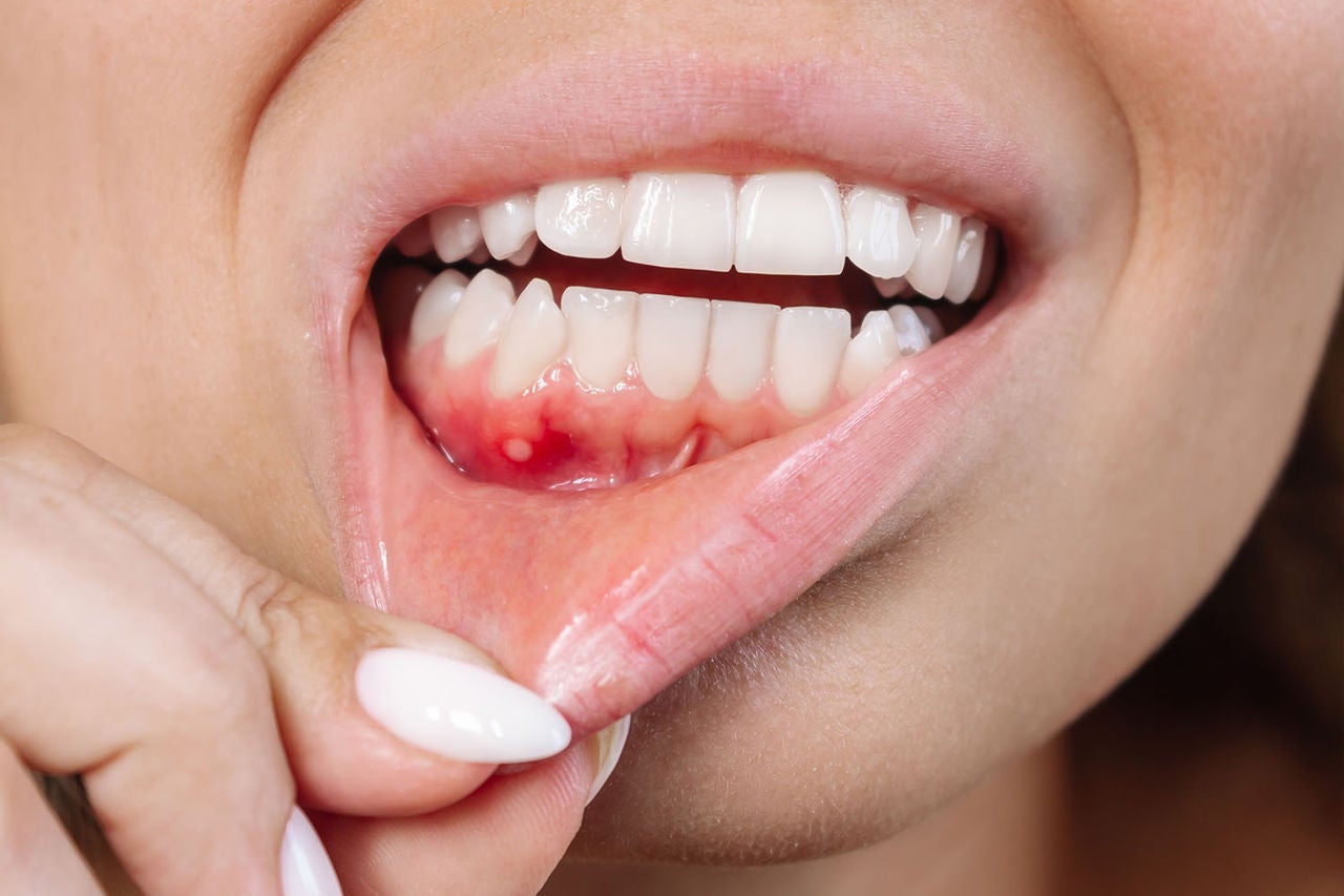 close ulcerative stomatitis on gums gum