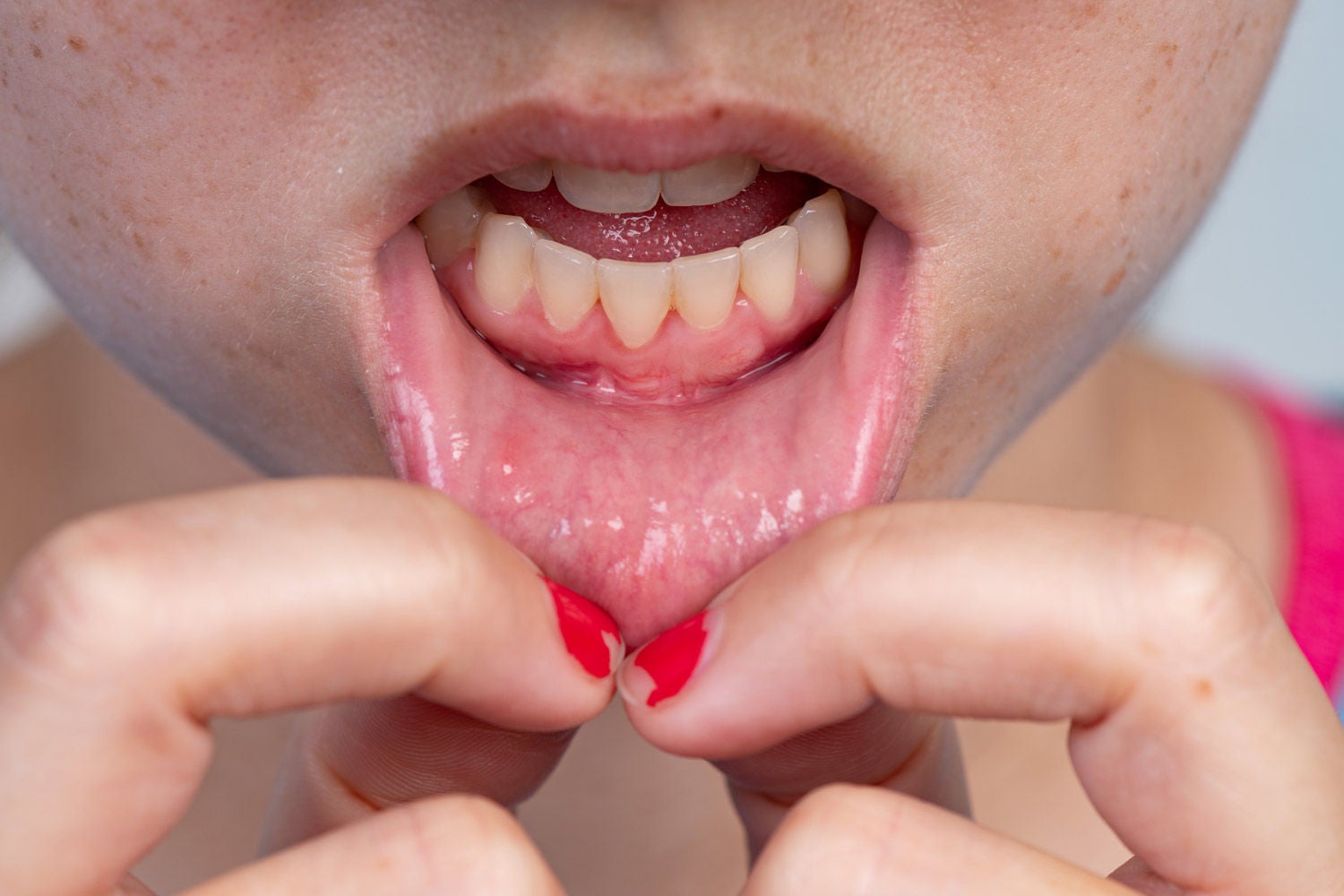 1492048484 gum recession after frenectomy