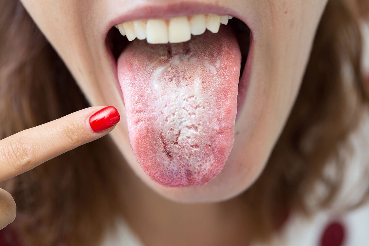 woman halitosis candida albicans pointing her