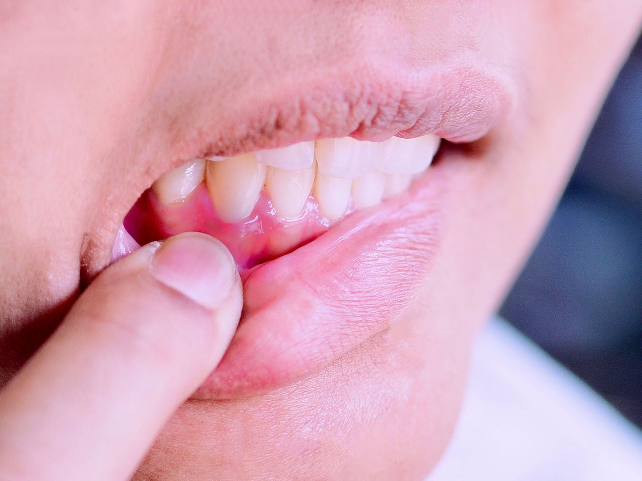 inflammation gums teeth
