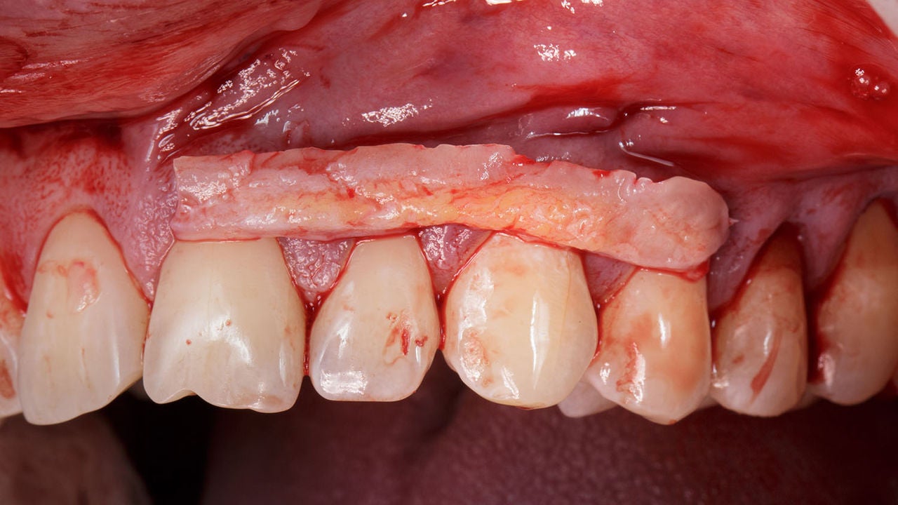 flap soft tissue graft on gum