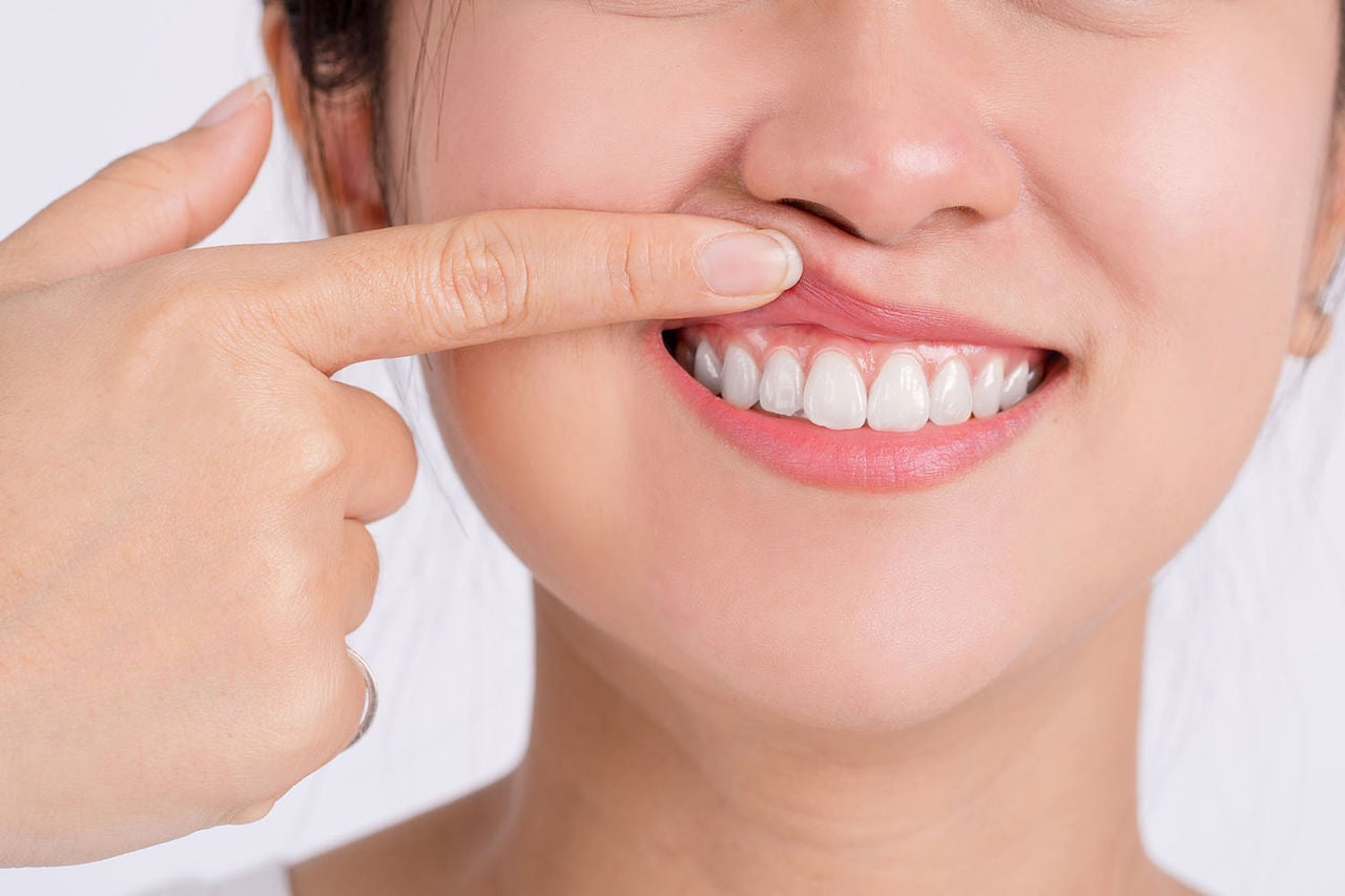 woman showing her upper gums finger