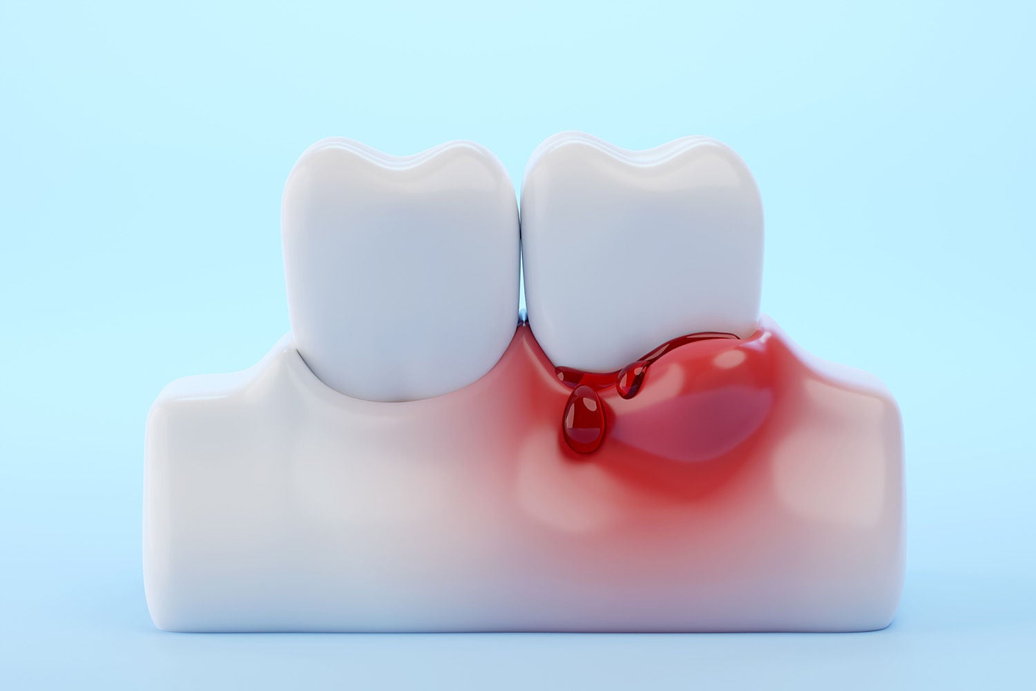 bleeding gums teeth blue background dental