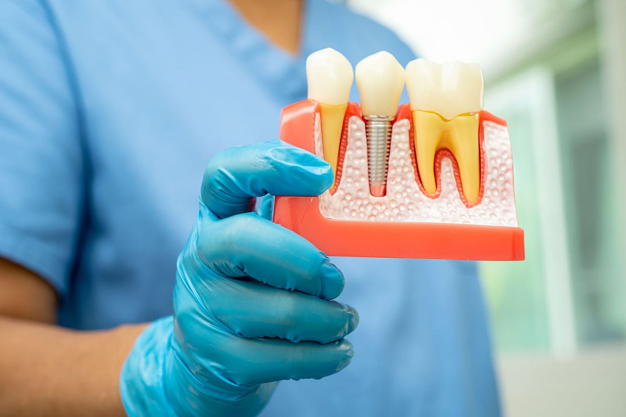 dental implant artificial tooth roots