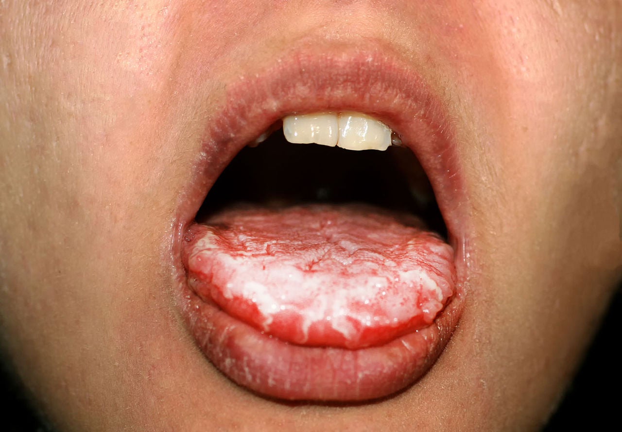 thrush tongue child candida