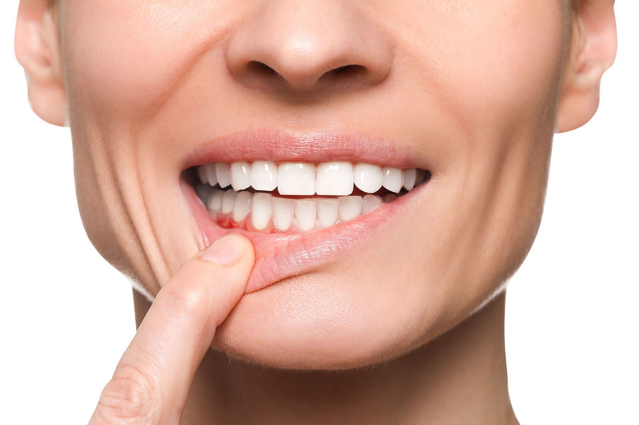 woman showing inflamed gum on white