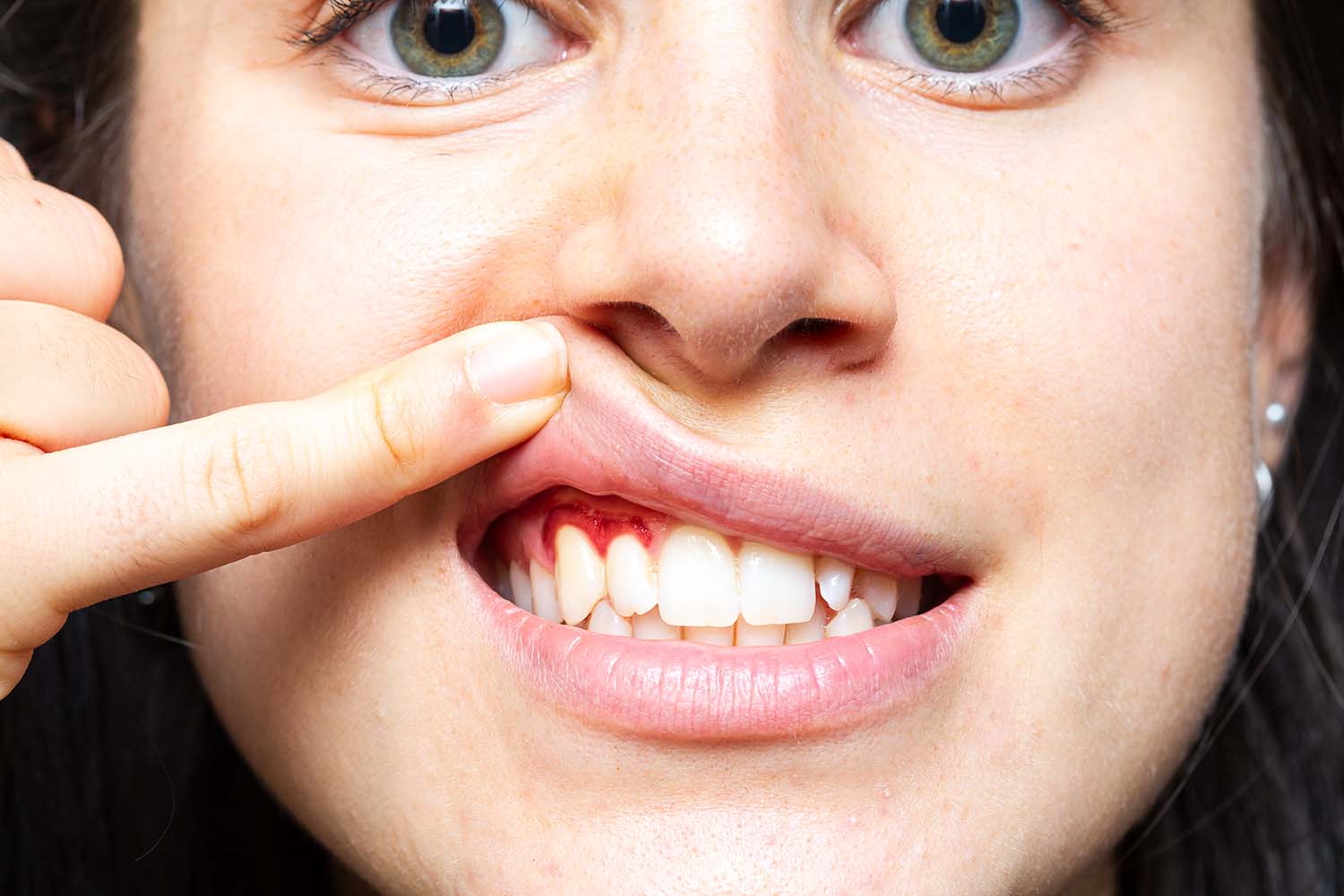 closeup girl bleeding gums lifting her